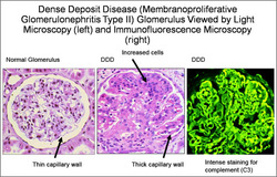 pathology of membranoproliferative glomerulonephritis 