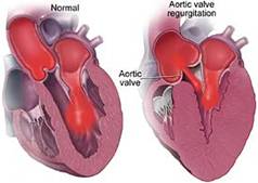 clinical examination of aortic regurgitation 