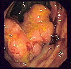 pathology of colorectal adenocarcinoma