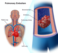 pathology of pulmonary embolism 