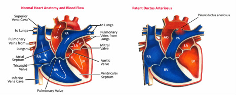 pathology of patent ductus arteriosus 