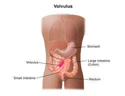 how to treat volvulus