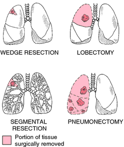 clinical examination of lobectomy 
