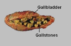 pathology of cholelithiasis ( gallstone)