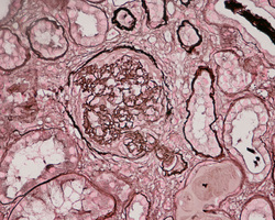 pathology of crescentic glomerulonephritis