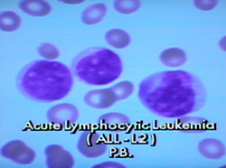 pathology of acute lymphoblastic leukemia