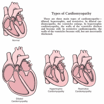 pathology of cardiomyopathy