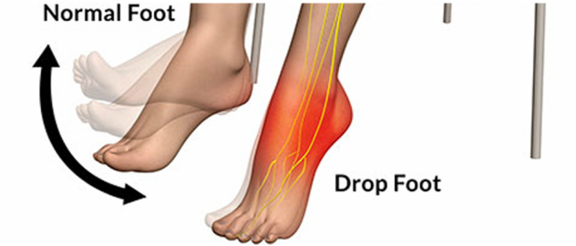 medical zone -foot drop 