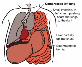 Pediatric Definition - Congenital Diaphragmatic Hernia 