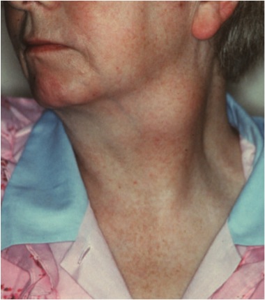 differential diagnosis of anterior triangle neck swelling 