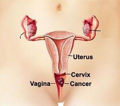 pathology of the carcinoma of the vagina