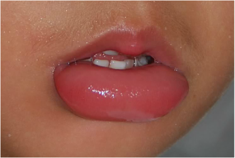 medical zone - lip swollen 