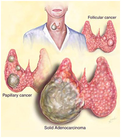 pathology of thyroid carcinoma 