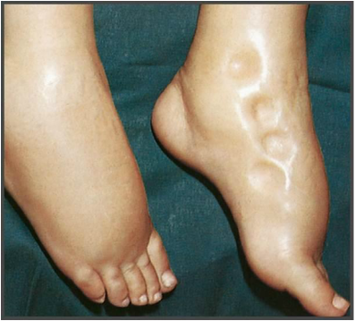 differential diagnosis - bilateral pitting ankle edema 