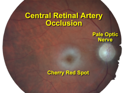 how to treat retinal artery occlusion