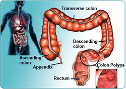 pathology of colonic polyps