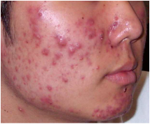 Pediatric definition - acne
