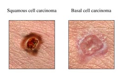 pathology of basal cell carcinoma 
