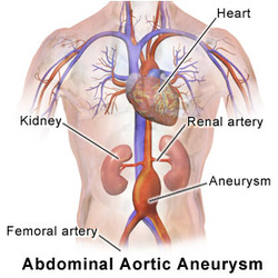 pathology of abdominal aortic aneurysm 
