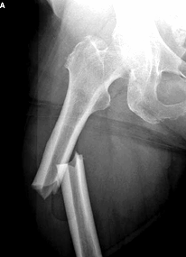 how to treat fracture of the femur 