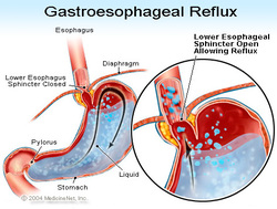 gastro esophageal reflux disease