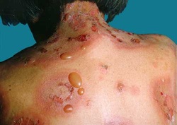 pathology of bullous pemphigoid 