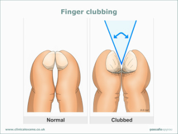 symptom finder- the causes of clubbing 