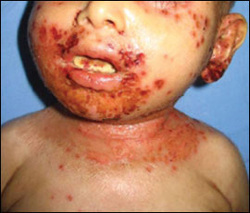 pathology of eczematous dermatitis