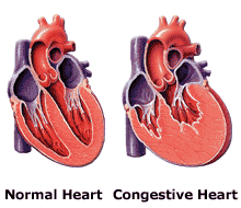 pathology of congestive heart failure 