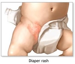 how to treat diaper rash