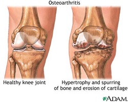 pathology of osteoarthritis 