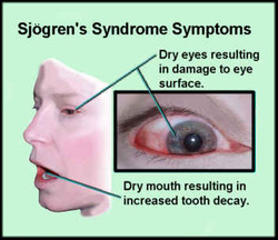 pathology of sjorgen syndrome