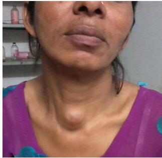 differential diagnosis of midline neck swelling 