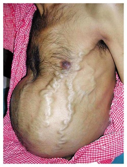 pathology of Budd Chiari syndrome