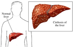 clinical examination of cirrhosis 