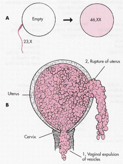 pathology of gestational choriocarcinoma 