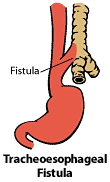 tracheoesophageal fistula pathology 