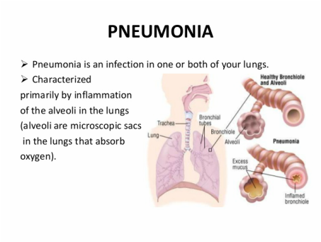 Pediatric definition - bacterial pneumonia 