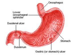 pathology of peptic ulcer
