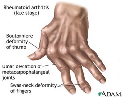 pathology of rheumatoid arthritis 