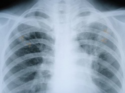 clinical examination of apical pulmonary fibrosis 