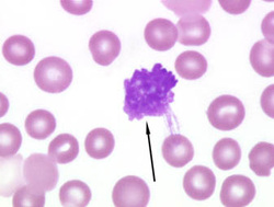 pathology of chronic lymphocytic leukemia 