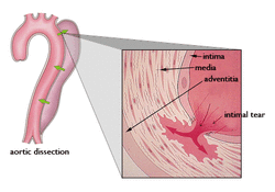 pathology of aortic dissection 