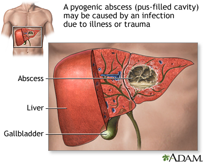 hepatic abscess