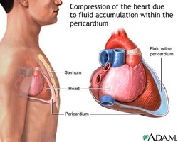 how to treat cardiac tamponade