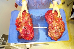causes of kidney enlargement
