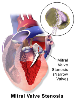 medical zone - mitral stenosis 