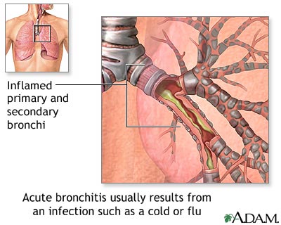 acute bronchitis symptoms 