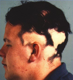medical zone - alopecia